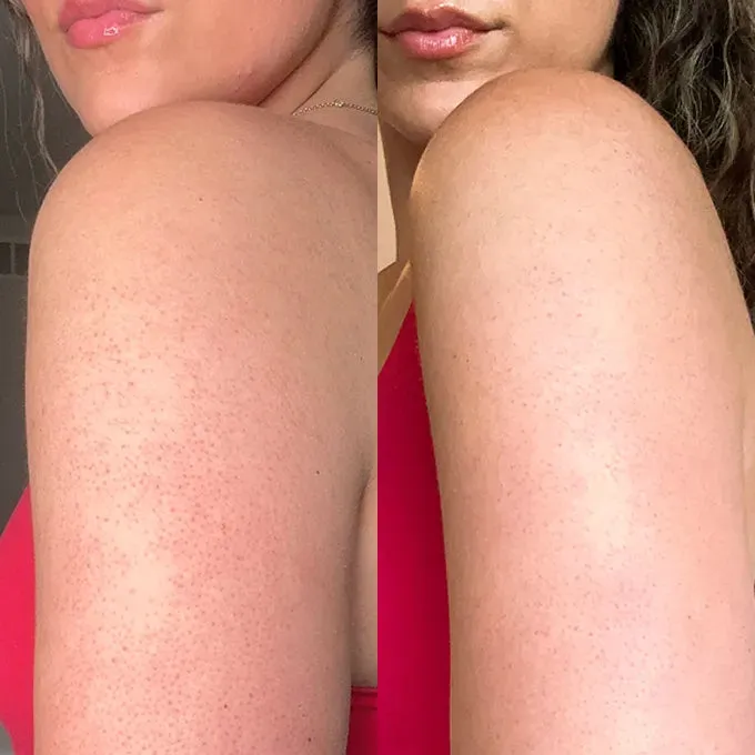 Official First Aid Beauty comparison showing rough, bumpy upper-arm skin and visibly smoother skin