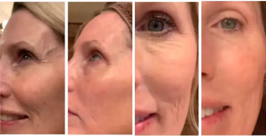 Four-panel facial skin comparison photo collage