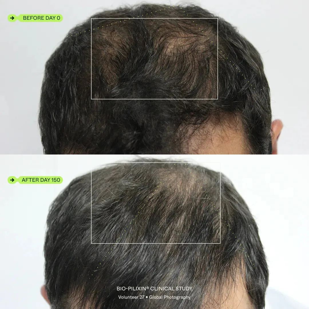 A man applying Bio-Pilixin serum to his scalp with a pipette