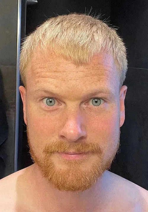 Niels after using Bio-Pilixin Activation Serum
