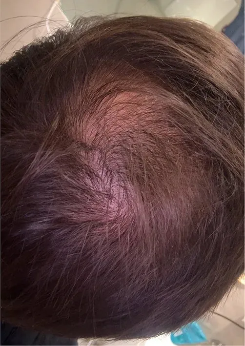 Jacob before using Bio-Pilixin Activation Serum