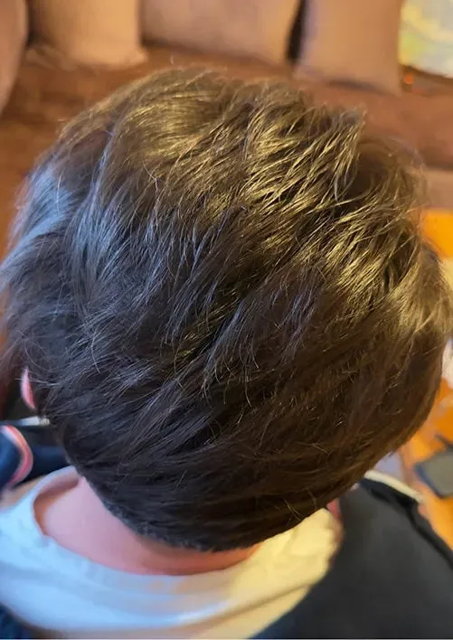 Jacob after using Bio-Pilixin Activation Serum